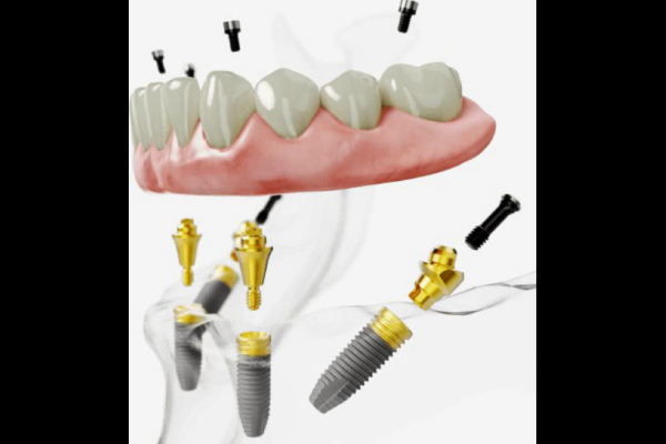 Advanced Dental Implantology
                
